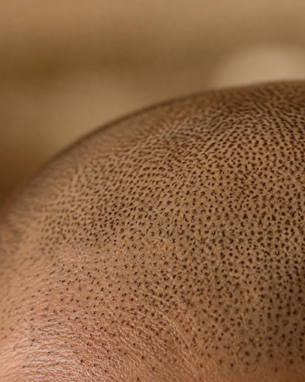 צילום מקרוב של נקודות פיגמנט SMP בקרקפת